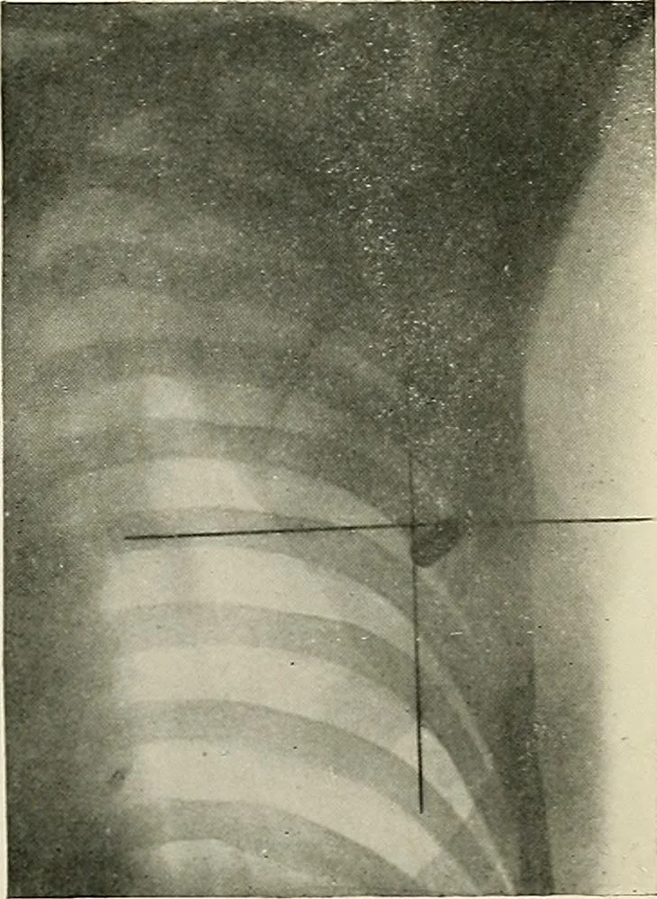 An illustration from Localization by X-rays and stereoscopy, 1916, leaf 126