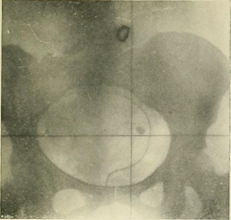 An illustration from Localization by X-rays and stereoscopy, 1916, leaf 128