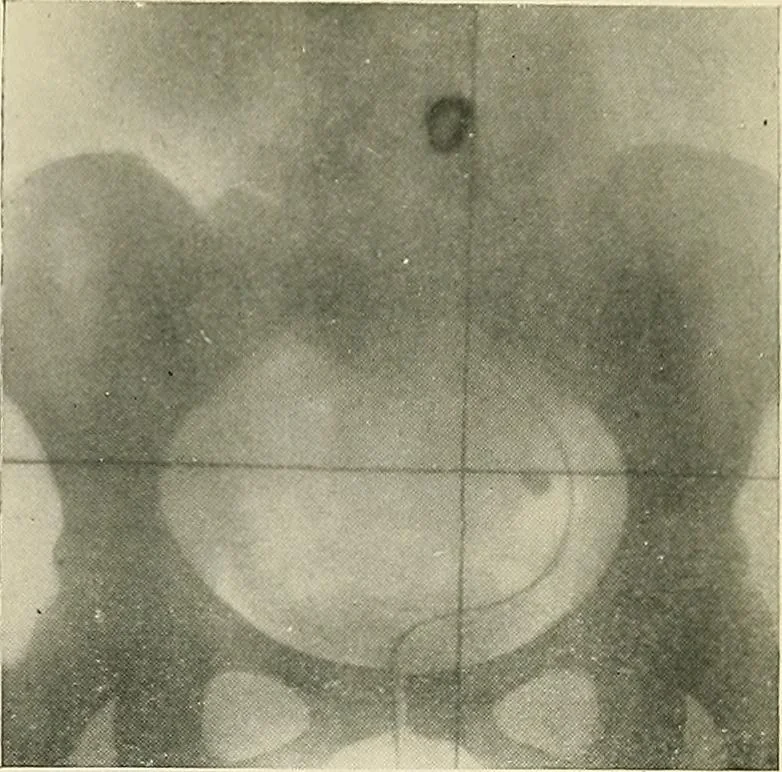 An illustration from Localization by X-rays and stereoscopy, 1916, leaf 128