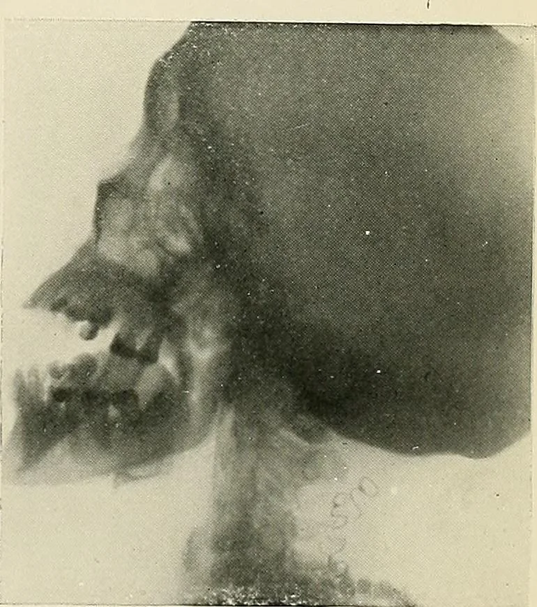 An illustration from Localization by X-rays and stereoscopy, 1916, leaf 128
