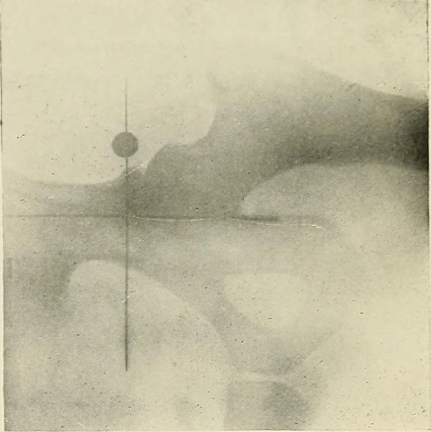 An illustration from Localization by X-rays and stereoscopy, 1916, leaf 130
