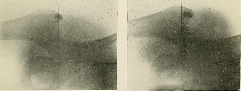 An illustration from Localization by X-rays and stereoscopy, 1916, leaf 130