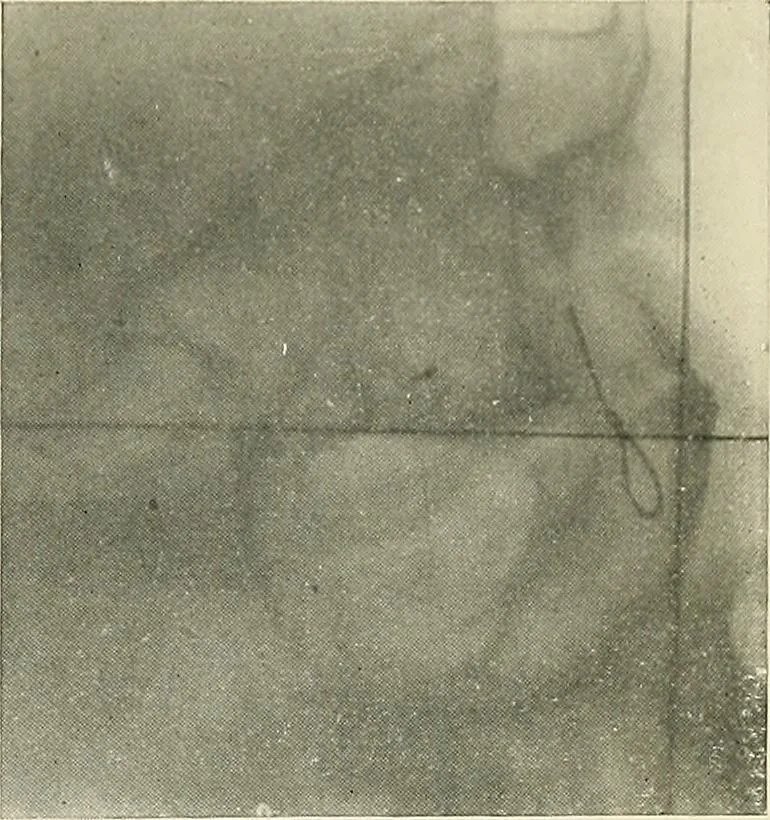 An illustration from Localization by X-rays and stereoscopy, 1916, leaf 132