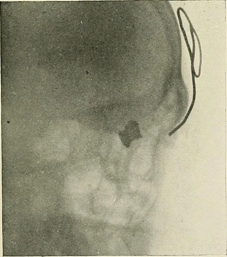 An illustration from Localization by X-rays and stereoscopy, 1916, leaf 132