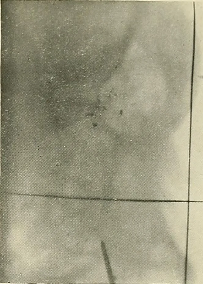 An illustration from Localization by X-rays and stereoscopy, 1916, leaf 134