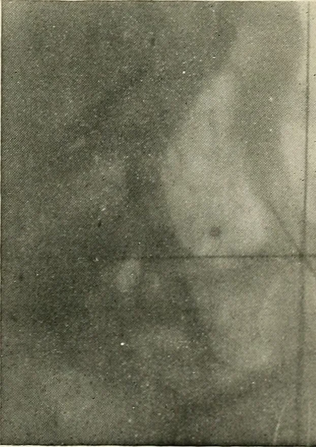 An illustration from Localization by X-rays and stereoscopy, 1916, leaf 134
