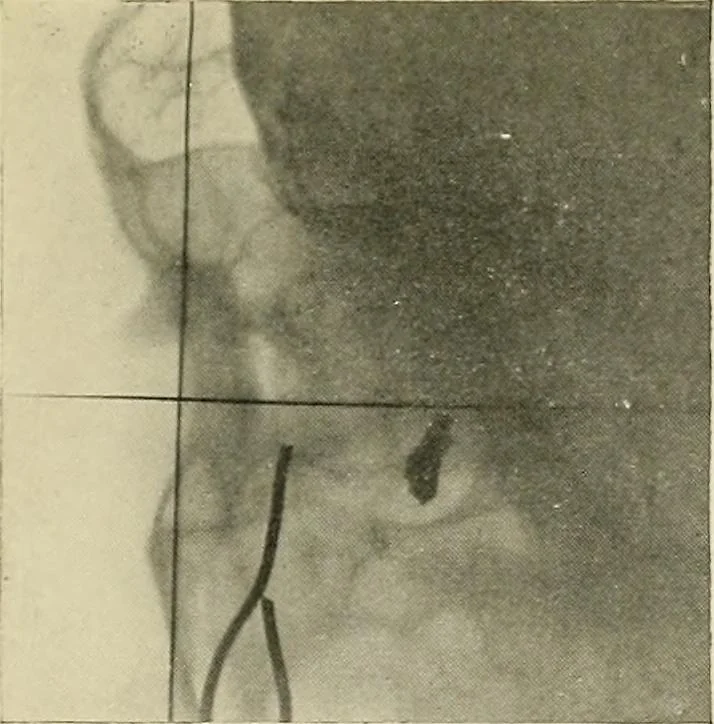An illustration from Localization by X-rays and stereoscopy, 1916, leaf 136
