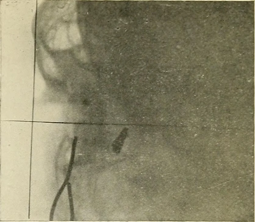 An illustration from Localization by X-rays and stereoscopy, 1916, leaf 136