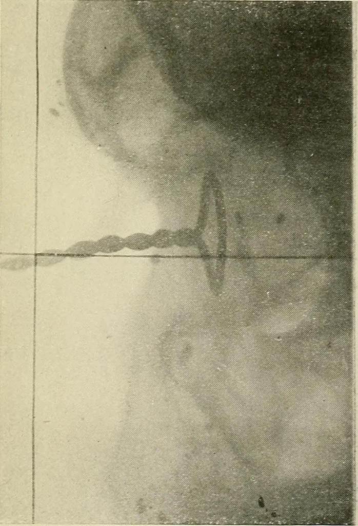 An illustration from Localization by X-rays and stereoscopy, 1916, leaf 136