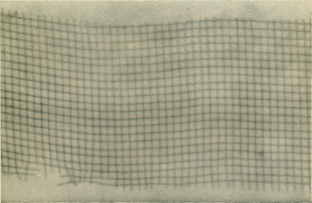 An illustration from Localization by X-rays and stereoscopy, 1916, leaf 42