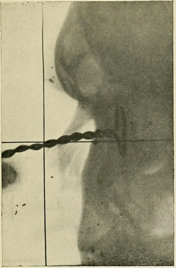 An illustration from Localization by X-rays and stereoscopy, 1916, leaf 94