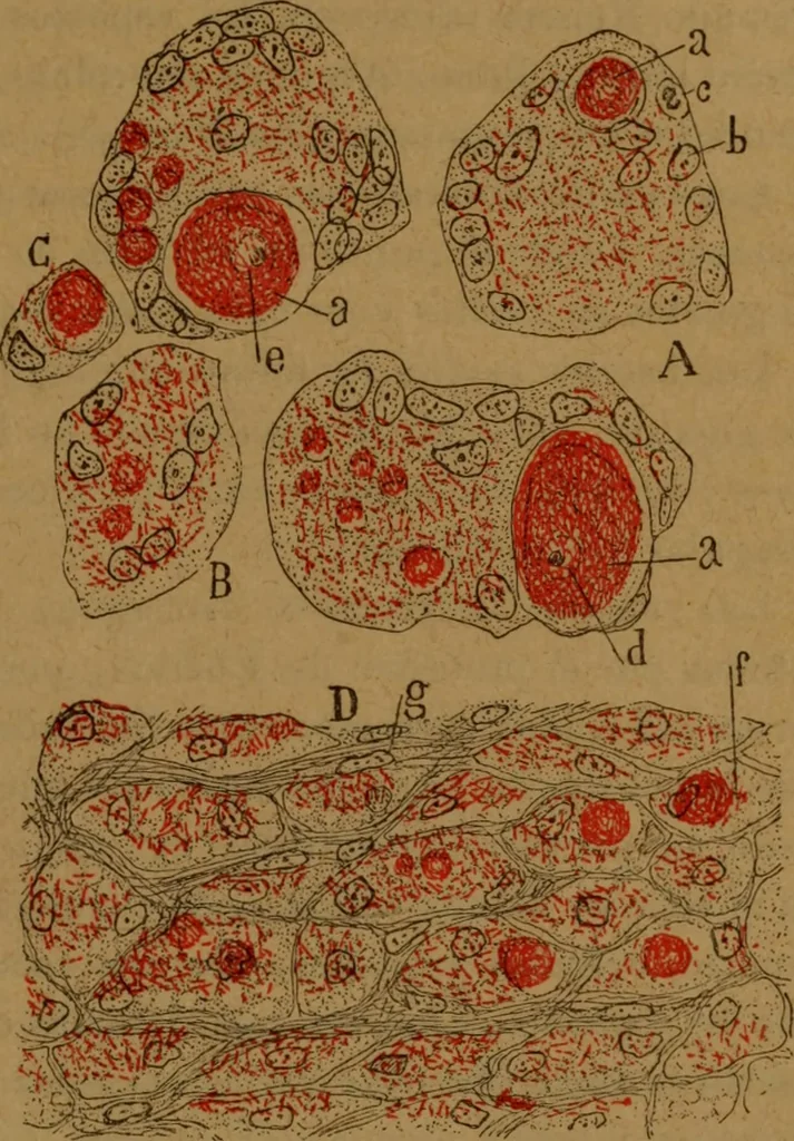 An illustration from Manual de anatomía patológica general : seguida de un resumen de microscopia aplicada a la histología y bacteriología patológicas, 1896, leaf 212