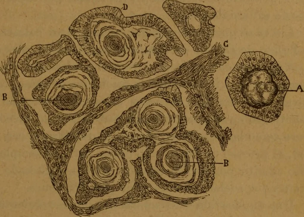 An illustration from Manual de anatomía patológica general : seguida de un resumen de microscopia aplicada a la histología y bacteriología patológicas, 1896, leaf 42