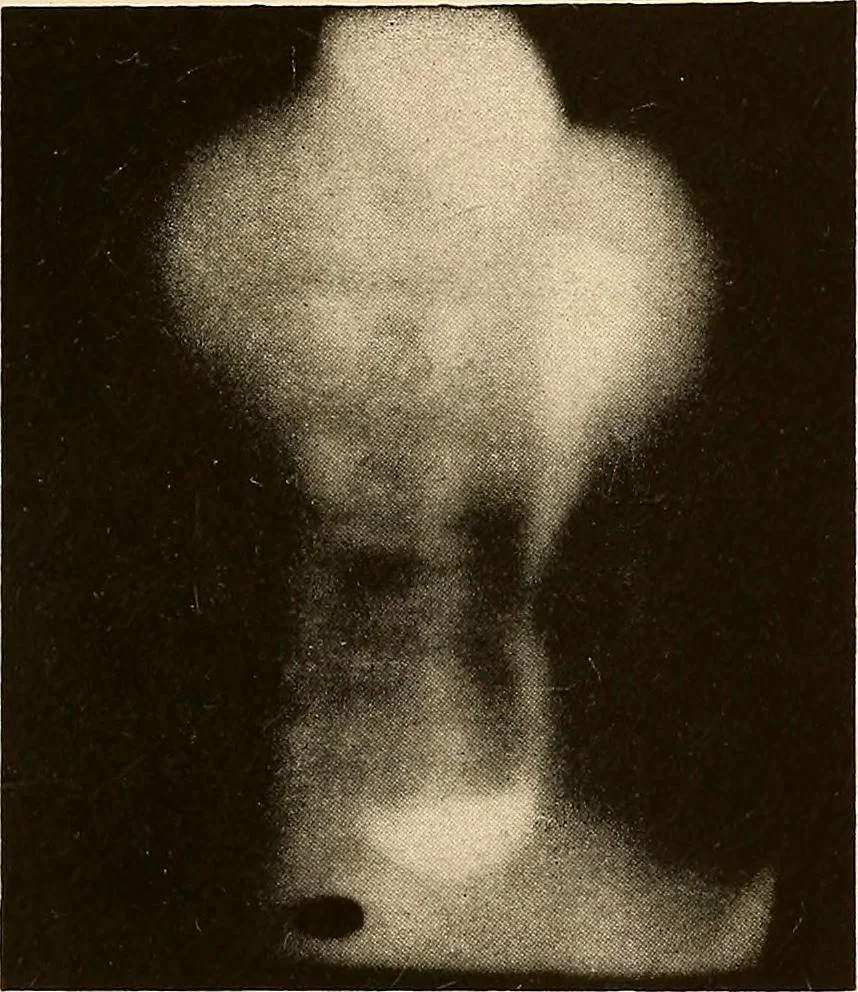 An illustration from A manual of X-ray technic, 1917, leaf 118