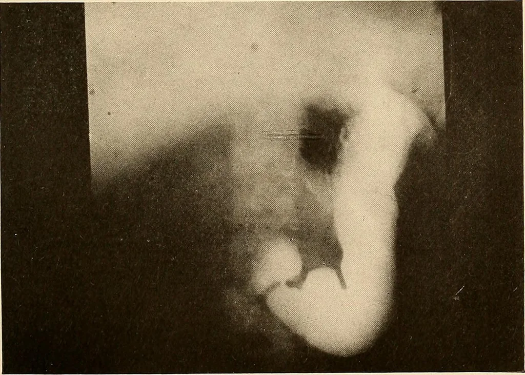 An illustration from A manual of X-ray technic, 1917, leaf 122