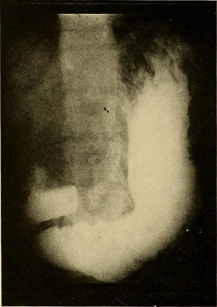 An illustration from A manual of X-ray technic, 1917, leaf 123