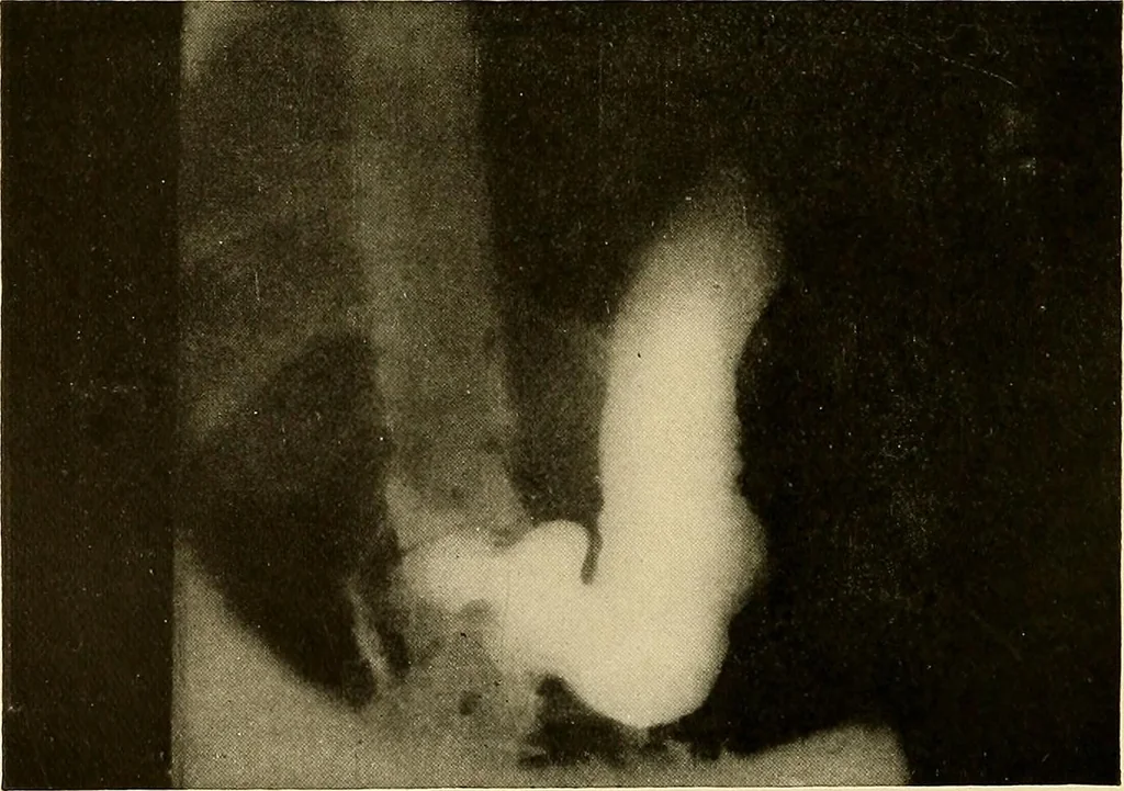 An illustration from A manual of X-ray technic, 1917, leaf 123