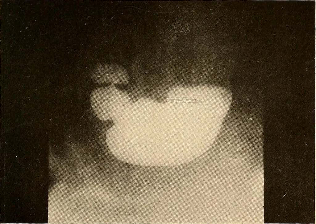 An illustration from A manual of X-ray technic, 1917, leaf 124