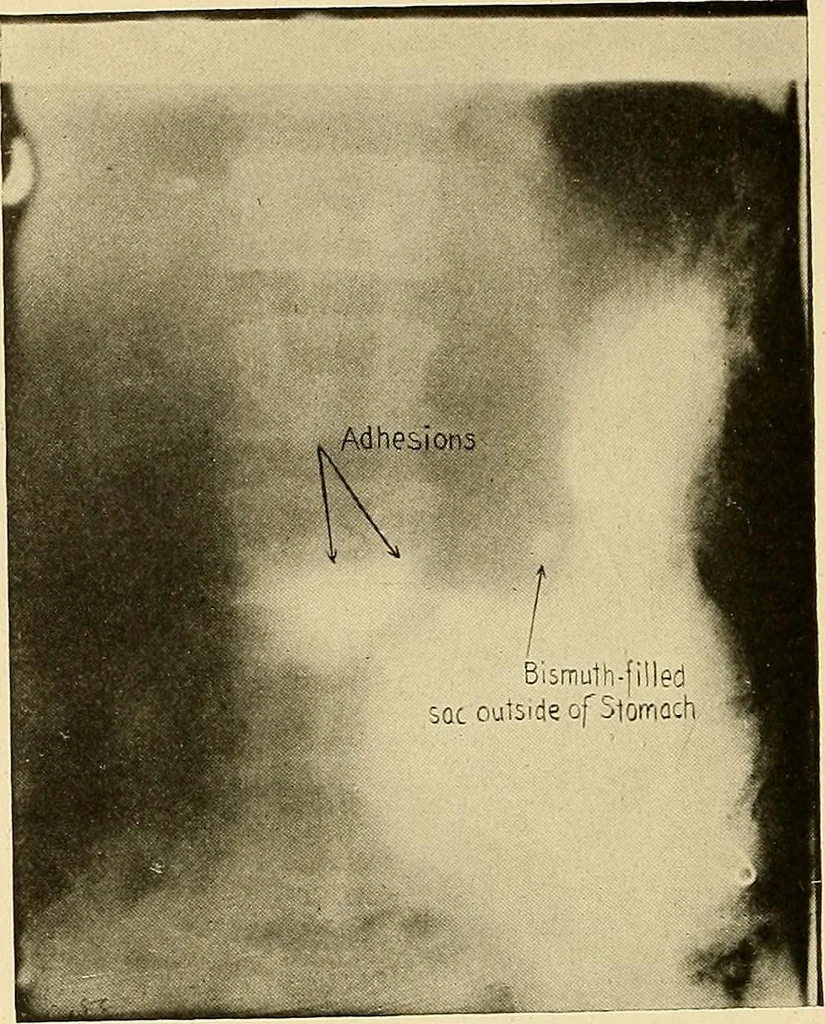 An illustration from A manual of X-ray technic, 1917, leaf 125