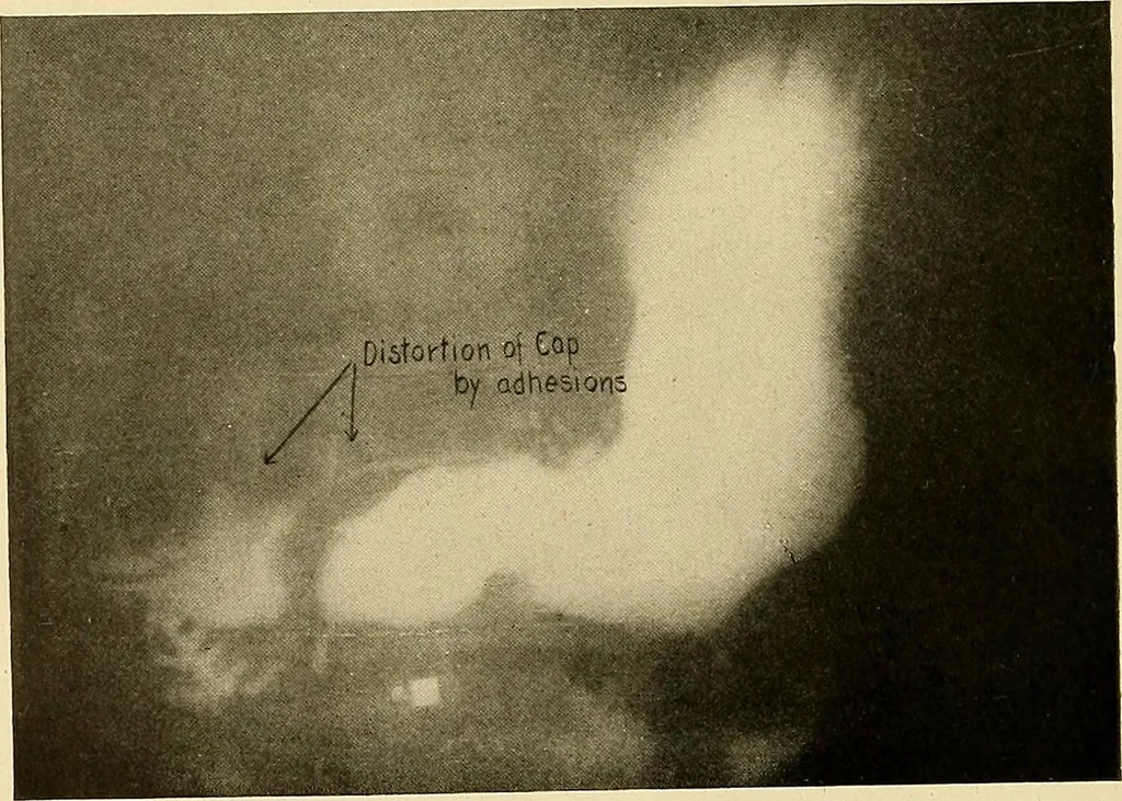 An illustration from A manual of X-ray technic, 1917, leaf 125
