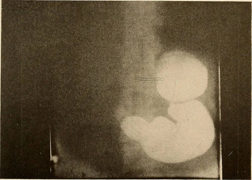 An illustration from A manual of X-ray technic, 1917, leaf 126