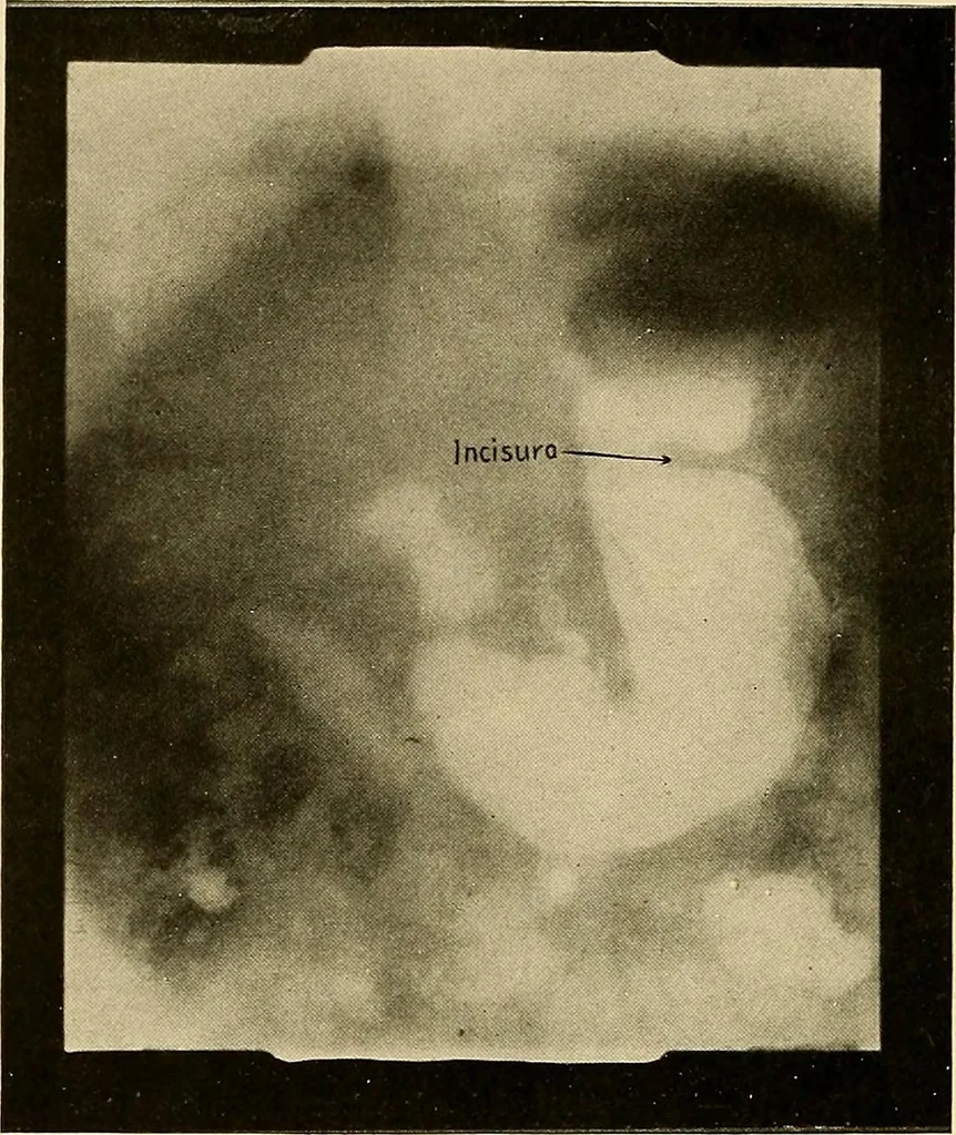 An illustration from A manual of X-ray technic, 1917, leaf 127