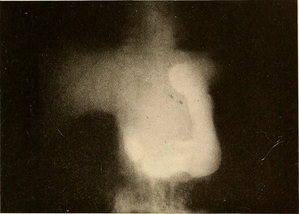An illustration from A manual of X-ray technic, 1917, leaf 132