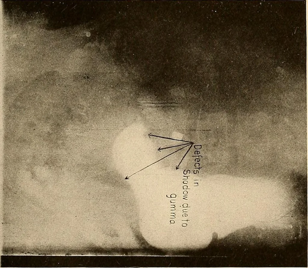 An illustration from A manual of X-ray technic, 1917, leaf 134