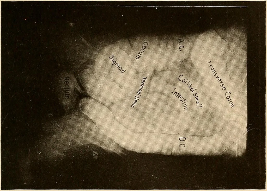 An illustration from A manual of X-ray technic, 1917, leaf 142