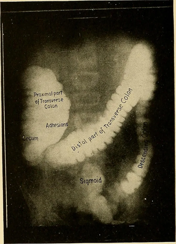 An illustration from A manual of X-ray technic, 1917, leaf 143