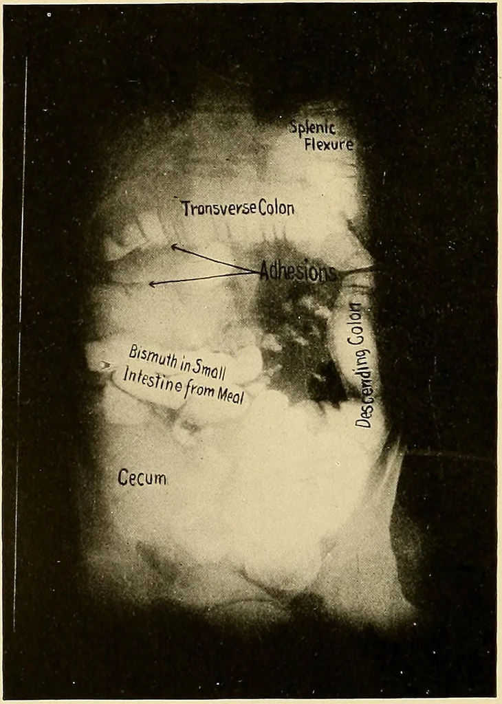 An illustration from A manual of X-ray technic, 1917, leaf 143