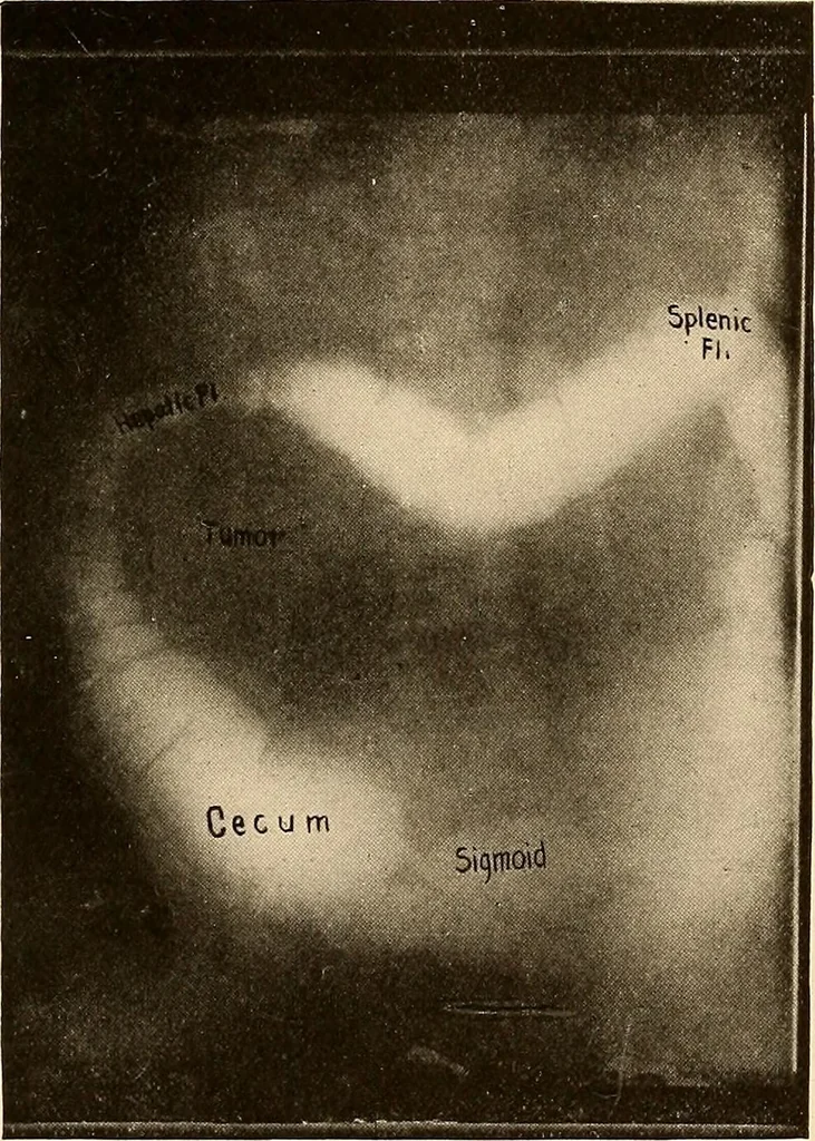 An illustration from A manual of X-ray technic, 1917, leaf 144