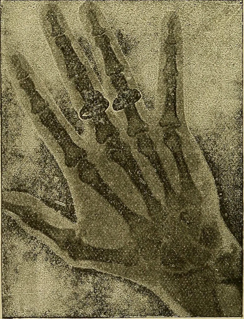An illustration from Manuel de radioscopie et de radiographie par l'emploi des rayons X, 1900, leaf 85