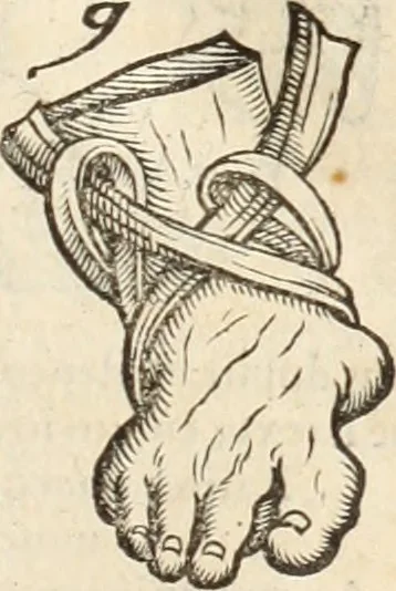 An illustration from Medicae artis principes, post Hippocratem & Galenum. Graeci Latinitate donati, Aretaeus, Ruffus Ephesius, Oribasius, Paulus Aegineta, Aëtius, Alex. Trallianus, Actuarius, Nic. Myrepsus. Latini, Corn. Celsus, Scrib. Largus, Marcell. Empiricus. Aliíque praeterea, quorum unius nomen ignoratur. Index non solùm copiosus, sed etiam ordine artificioso omnia digesta habens. Hippocr. aliquot loci cum Corn. Celsi interpretatione, 1567, leaf 86