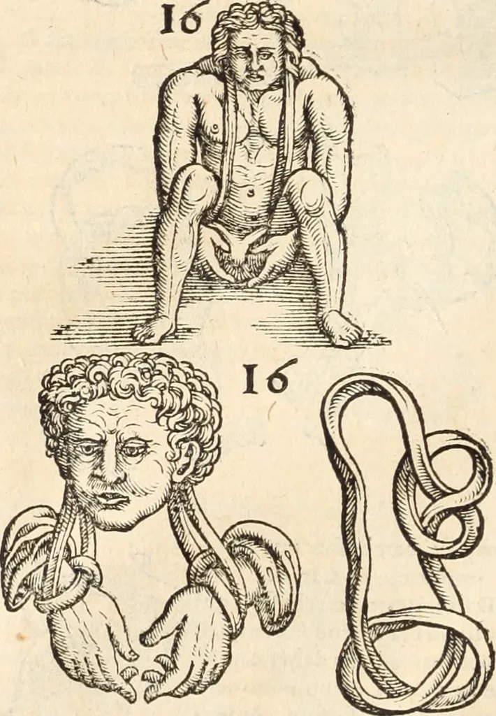 An illustration from Medicae artis principes, post Hippocratem & Galenum. Graeci Latinitate donati, Aretaeus, Ruffus Ephesius, Oribasius, Paulus Aegineta, Aëtius, Alex. Trallianus, Actuarius, Nic. Myrepsus. Latini, Corn. Celsus, Scrib. Largus, Marcell. Empiricus. Aliíque praeterea, quorum unius nomen ignoratur. Index non solùm copiosus, sed etiam ordine artificioso omnia digesta habens. Hippocr. aliquot loci cum Corn. Celsi interpretatione, 1567, leaf 87