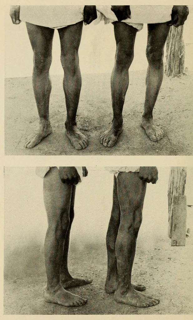 An illustration from Medical observations on the Zuñi Indians, 1924, leaf 20