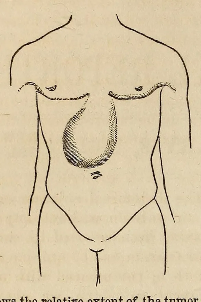 An illustration from The Medical and surgical reporter, 1858, leaf 522