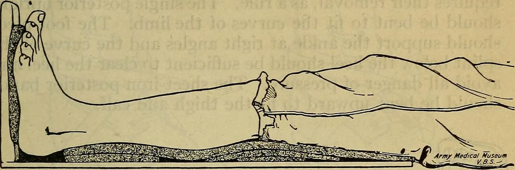 An illustration from Military surgery of the zone of the advance, 1918, leaf 244