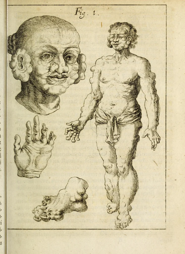 An illustration from Miscellanea Curiosa, sive Ephemiridum Medico-Physicarum Germanicarum Academiae Naturae Curiosorum, 1684, leaf 37