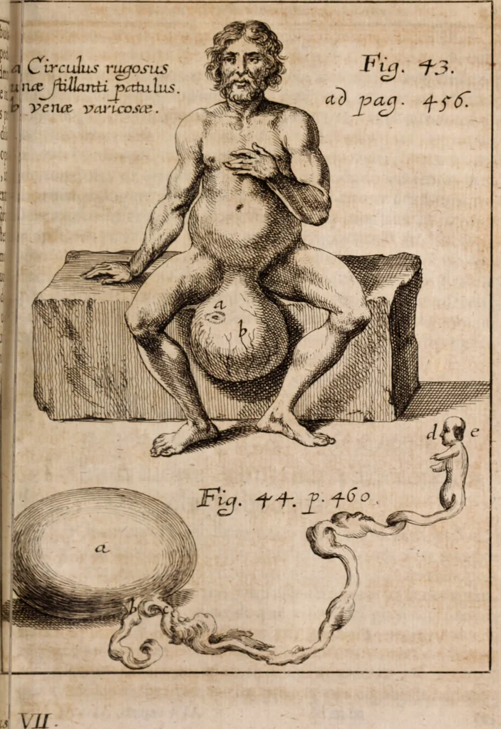 An illustration from Miscellanea curiosa, sive, Ephemeridum medico-physicarum Germanicarum Academiae Naturae curiosorum, 1688, leaf 1768