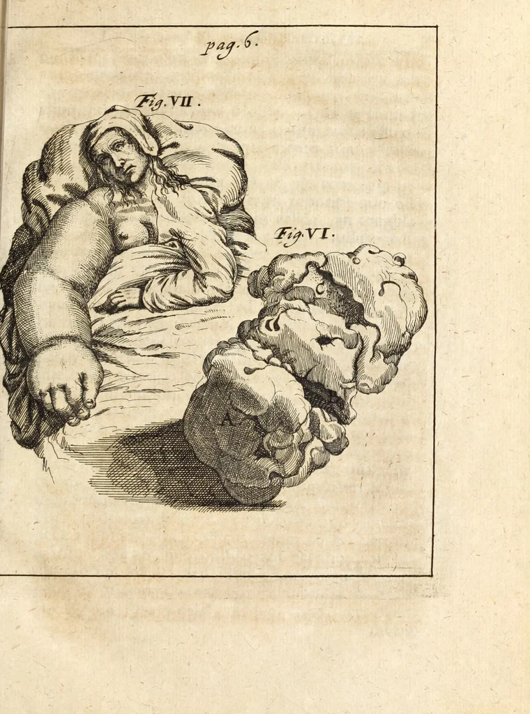 An illustration from Miscellanea curiosa, sive, Ephemeridum medico-physicarum Germanicarum, 1700, leaf 56