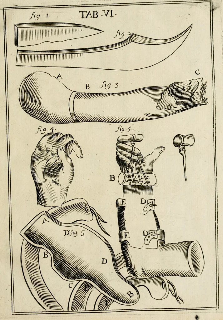 An illustration from Observations chirvrgiqves, 1669, leaf 34