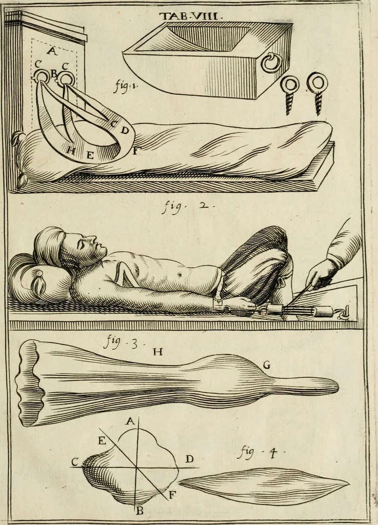 An illustration from Observations chirvrgiqves, 1669, leaf 38