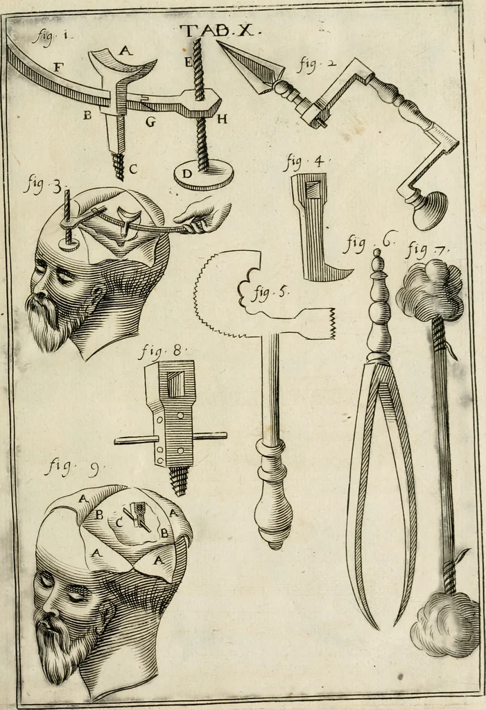 An illustration from Observations chirvrgiqves, 1669, leaf 42