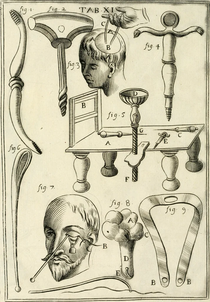 An illustration from Observations chirvrgiqves, 1669, leaf 45