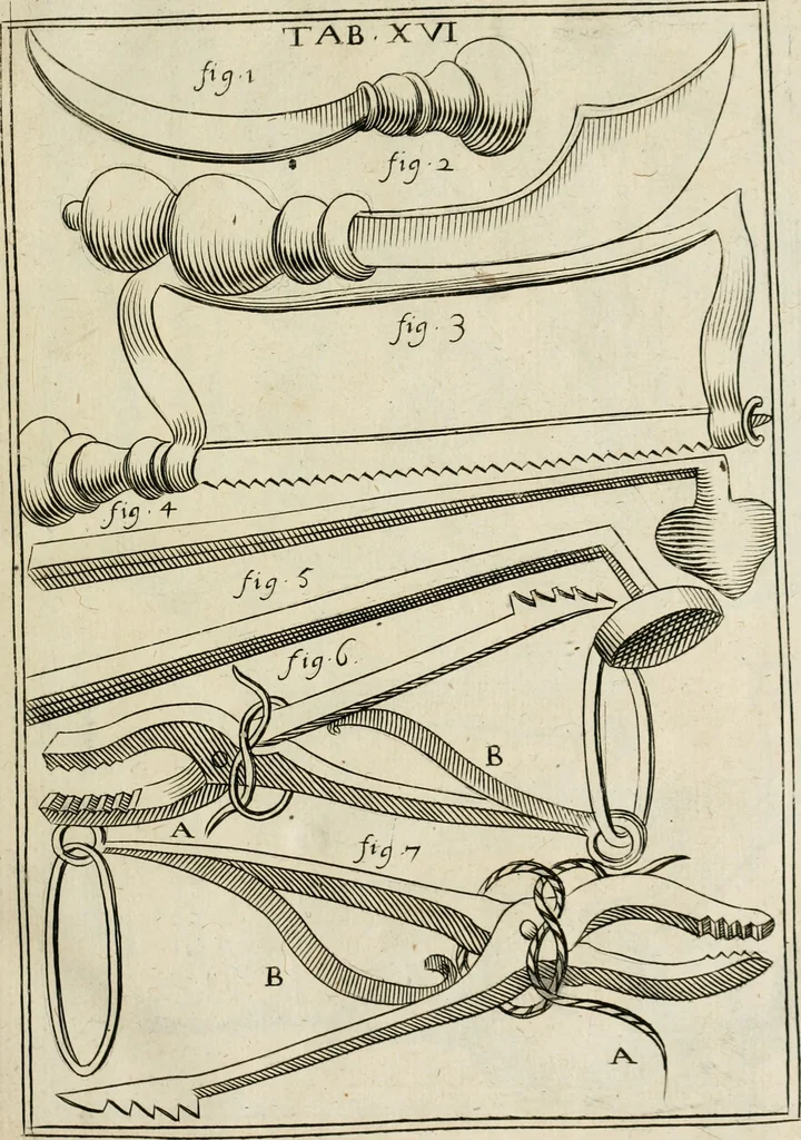 An illustration from Observations chirvrgiqves, 1669, leaf 54
