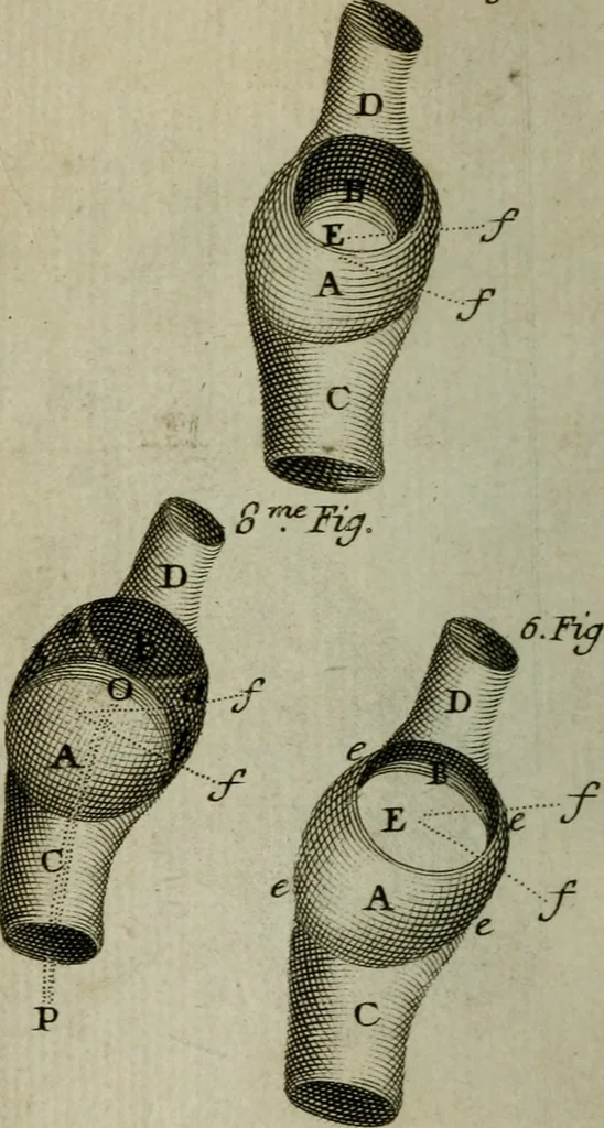 An illustration from Observations sur la maniere de tailler dans les deux sexes pour l'extraction de la pierre, pratiquée par Frere Jacques, 1700, leaf 161
