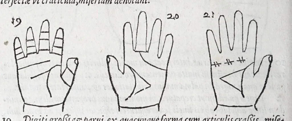 An illustration from Opvs mathematicvm octo libros complectens : innvmeris propemodvm figvris idealibvs manvvm et physiognomiae, aliisqve adornatvm, qvorvm sex priores libri absolutissimae cheiromantiae theoricam, praxim, doctrinam, artem, & experientiam verissimam continent : septimus physiognomiae dispositionem, hominumque omnium qualitates & complexiones : octauus periaxiomata de faciebus signorum, & quid sol in vnaquaque domo existens, natis polliceatur : remedia quoq; omnium aegritudinum complectitur : et naturalem astrologiam atq; effectus lunae quoad diuersas aegritudines : item isagogen astrologiae iudiciariae, & totius diuinatricis artis encomia ..., 1562, leaf 238