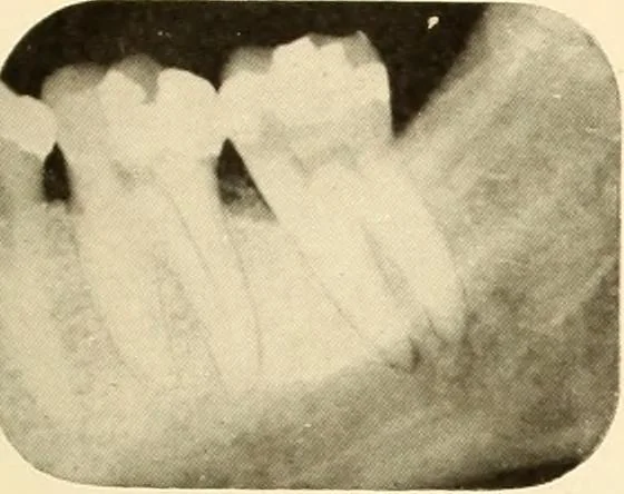 An illustration from Oral Roentgenology : a Roentgen study of the anatomy and pathology of the oral cavity, 1917, leaf 100