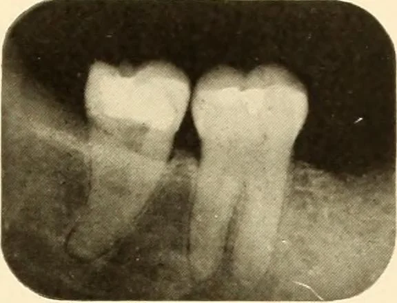 An illustration from Oral Roentgenology : a Roentgen study of the anatomy and pathology of the oral cavity, 1917, leaf 100